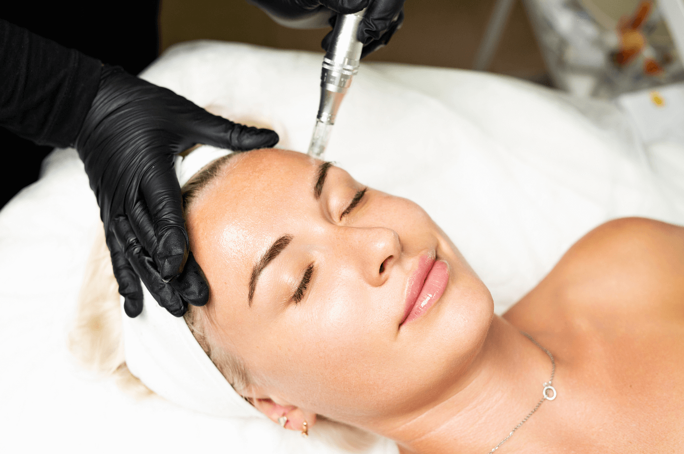 Nahaufnahem von einer Frau bei einer Microneedling behandlung
