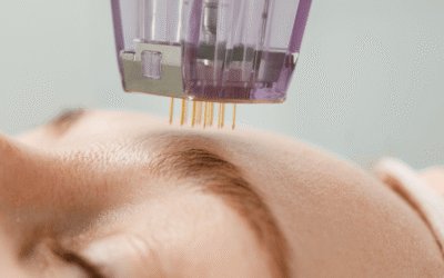 Microneedling: Für welche Hautprobleme ist es wirklich geeignet?