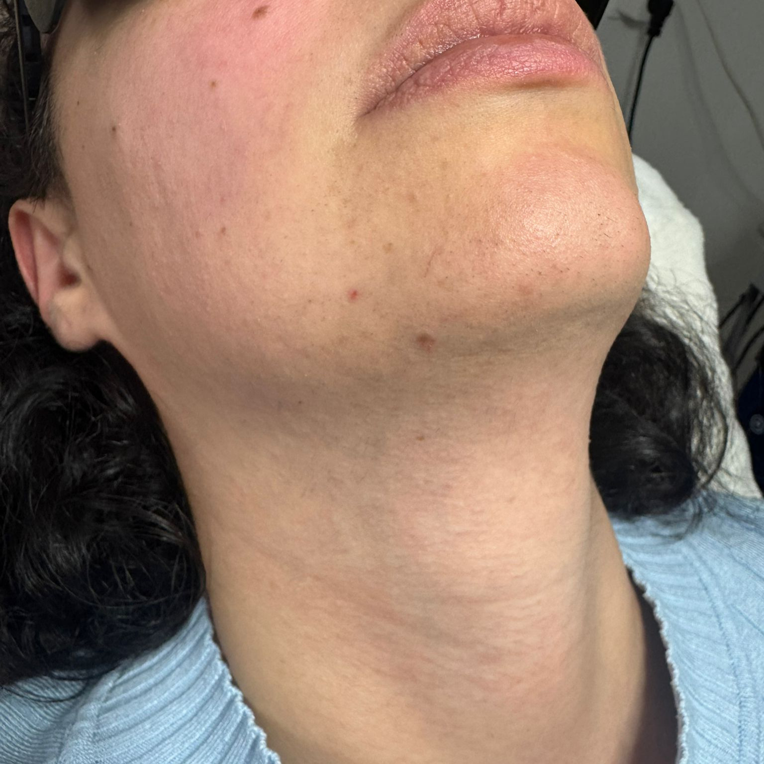 3.Sitzung Laser behandlung