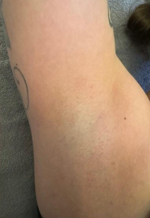 Nachher Diodenlaser