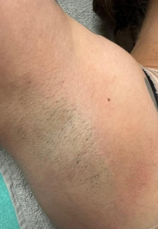 Vorher Diodenlaser